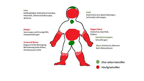 Symptome: Wo können Schwellungen auftreten?